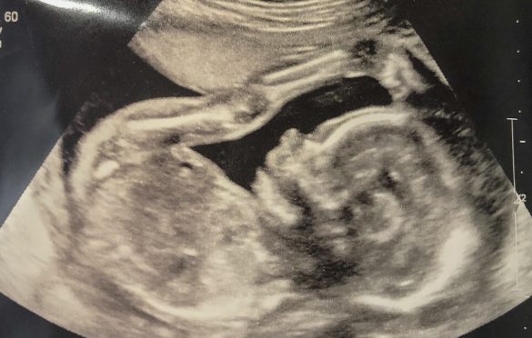 Baby curled up deals in womb ultrasound